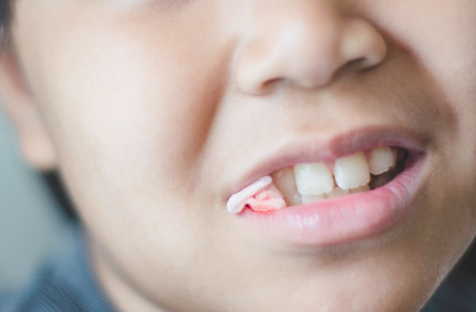 Close-up of a child's mouth as they bite onto a piece of gauze.