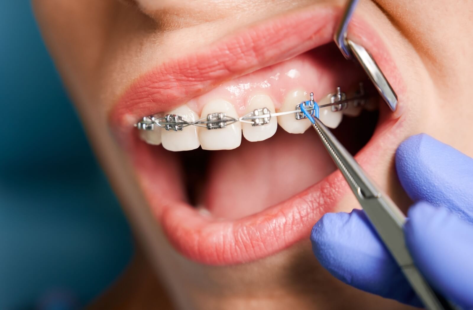 Close-up of metal braces as an orthodontist applies elastic rings around the brackets.