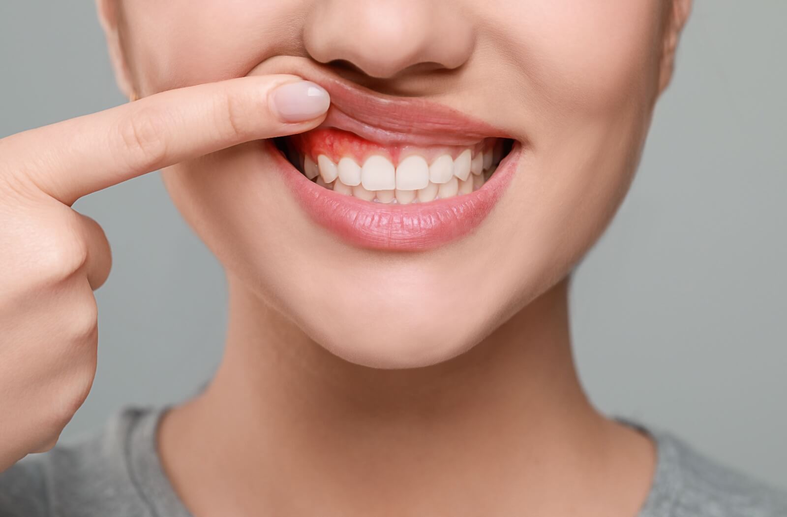 Woman showing red, irritated gums, a sign of gum disease.