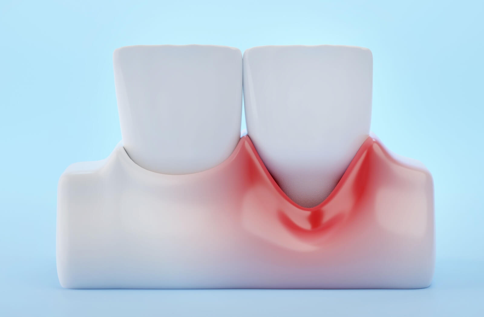 Mock up of teeth showing signs of gingivitis, including red and swollen gums, caused by improper oral care.