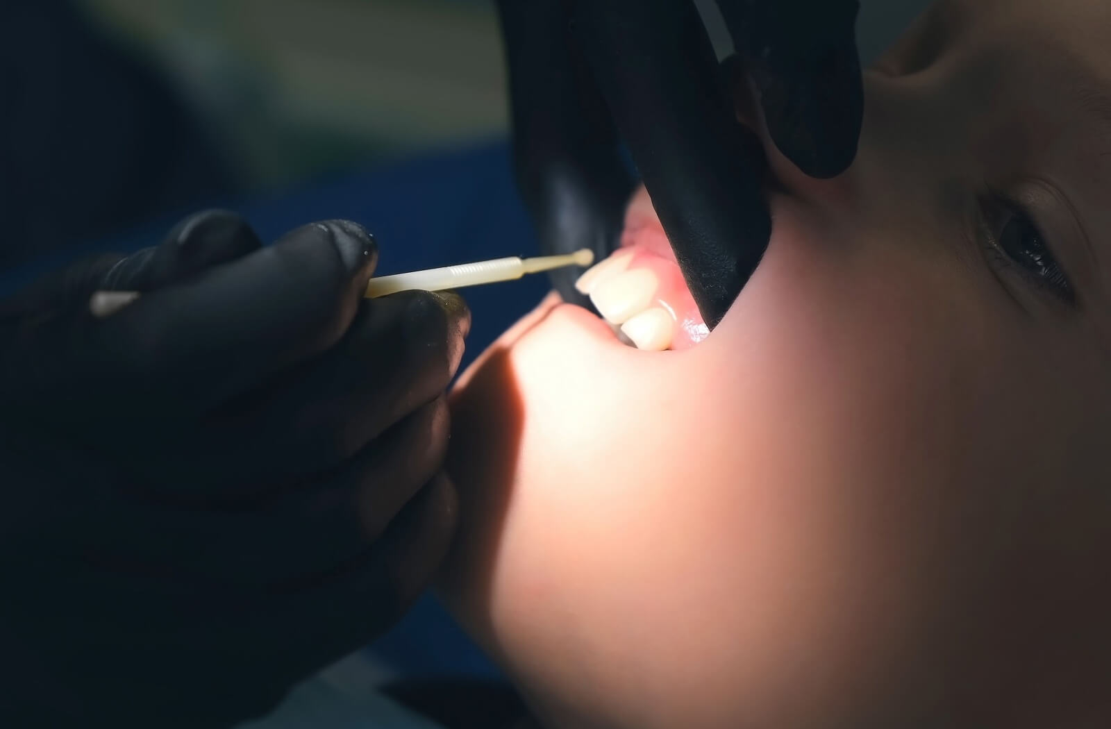 A dentist applies a fluoride gel to a patient's teeth to whiten them in the office.