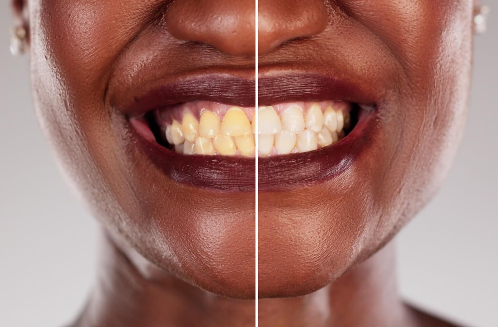 A comparison photo shows someone's teeth, yellowed on one side, and whitened on the other side.