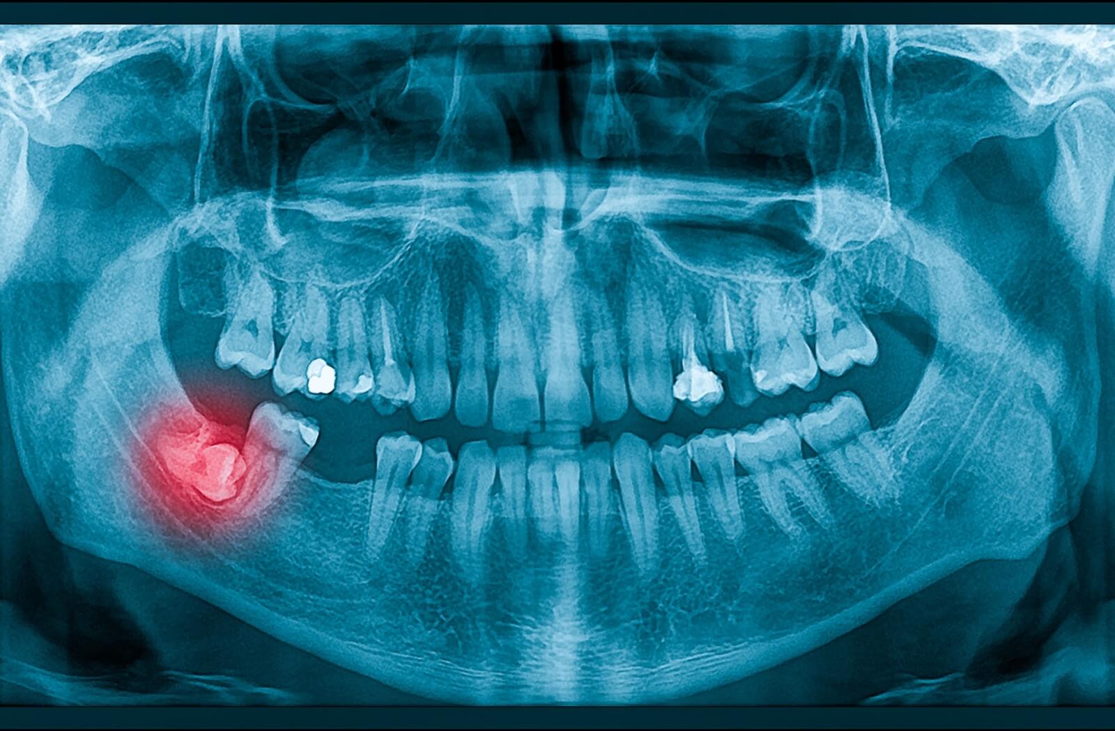 An x-ray image of an impacted wisdom tooth.